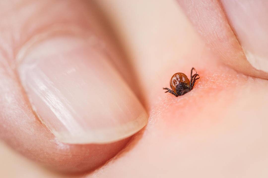 老人离世，儿子睡其生前床上确诊同症！医生：蜱虫病毒引发“母子同病”