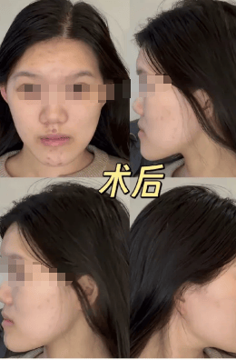 24岁女孩正颌手术被做反成“鞋拔子脸”，武汉大学口腔医院通报：已成立专项调查组，当事医生已停诊配合调查